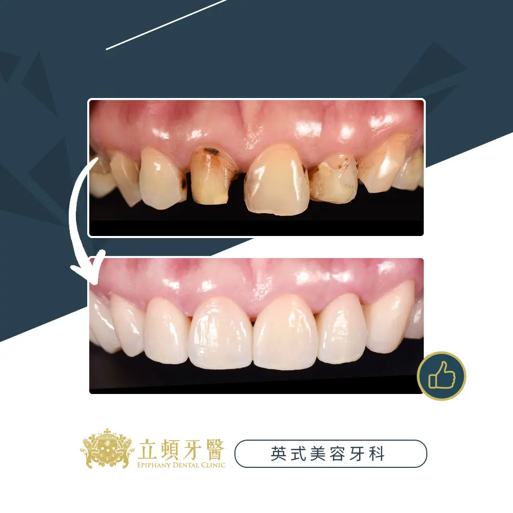陶瓷假牙的3個為什麼？美學牙醫來解答