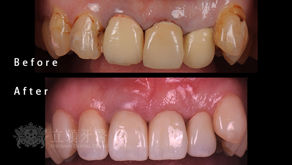 人工植牙實際案例 L01 0828