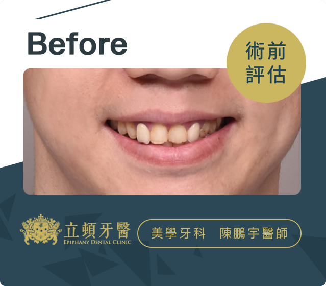 立頓牙醫患者-廖國翔案例Before
