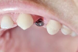 real mouth with dental molar screw implant 2022 09 03 00 27 10 utc
