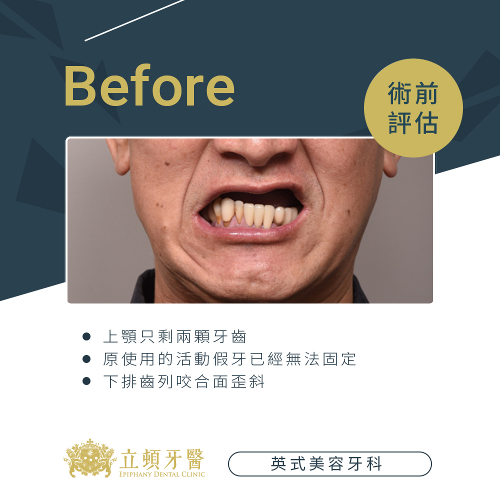 invisalign case ldr 1