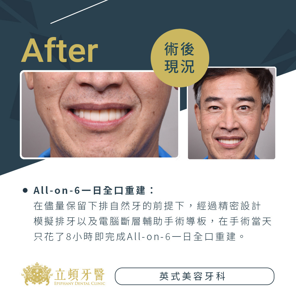 invisalign case ldr 2 1