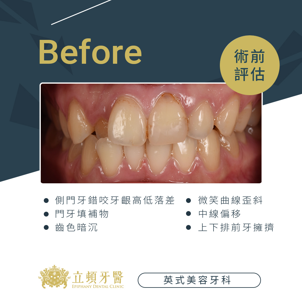 invisalign case lms 1