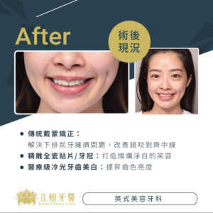 invisalign case lms 2