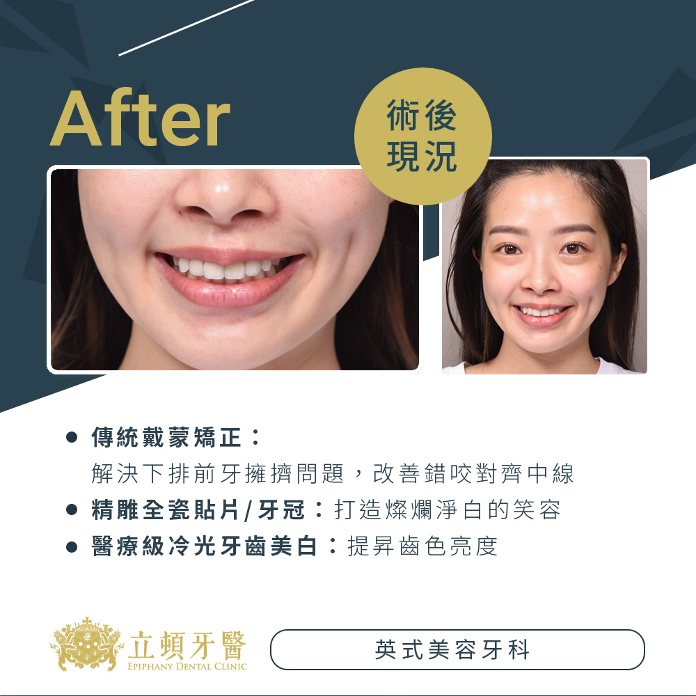 invisalign case lms 2