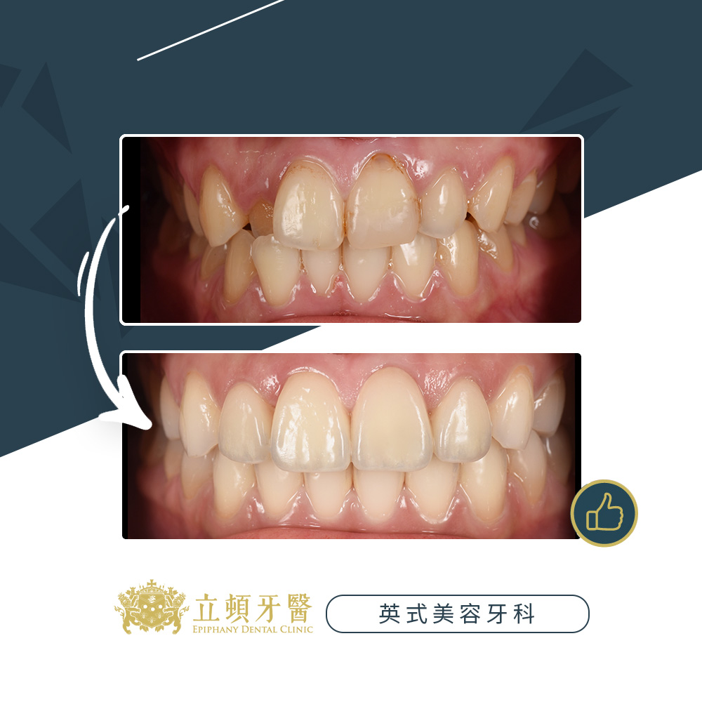 invisalign case lms 3