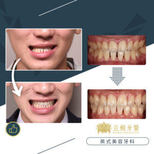 invisalign case wdr 1