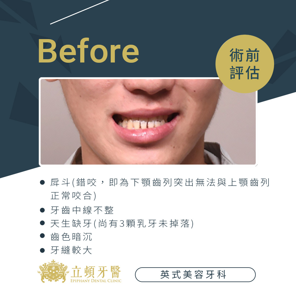 invisalign case wdr 2