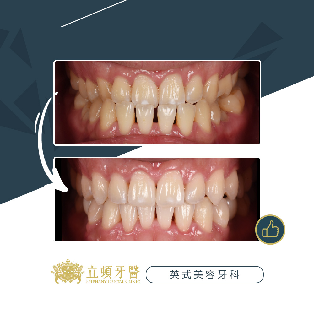 invisalign case wdr 4