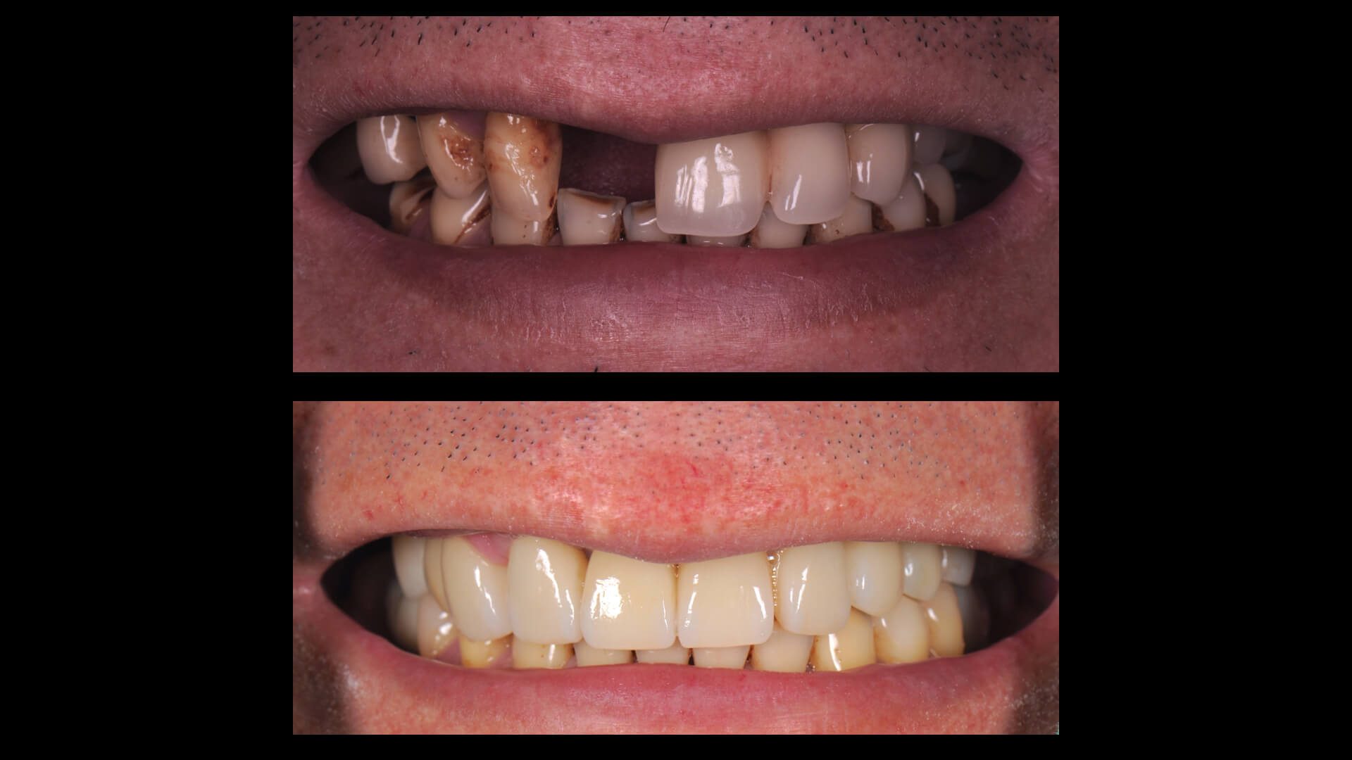 為什麼全瓷冠壽命會減短呢？立頓牙醫解答全瓷牙冠壽命如何延長