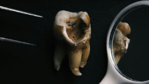macro shot of a decayed teeth till root after extr 2023 11 27 05 05 23 utc